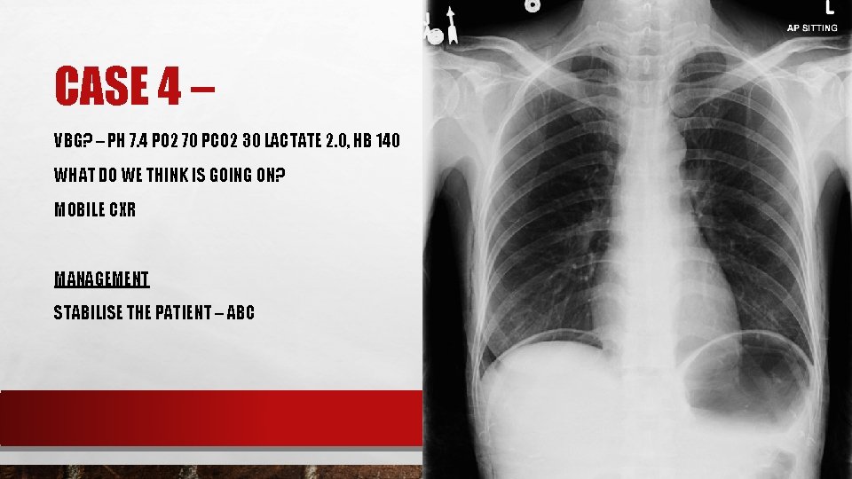 CASE 4 – VBG? – PH 7. 4 PO 2 70 PCO 2 30 CASE 4 – VBG? – PH 7. 4 PO 2 70 PCO 2 30