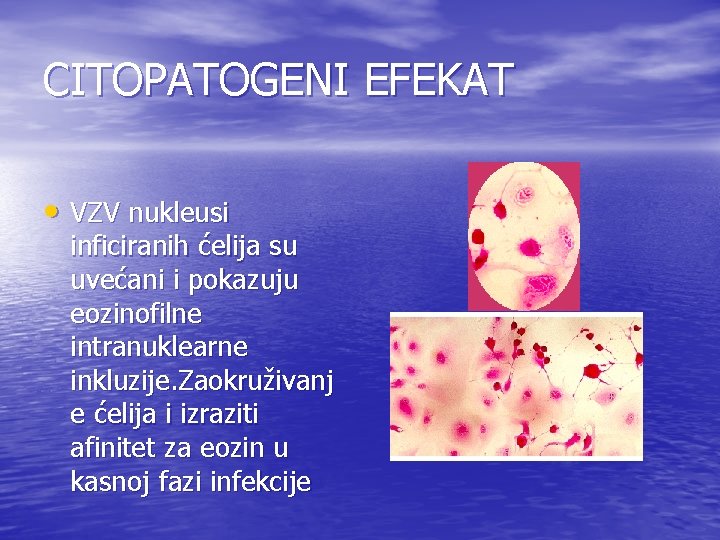 CITOPATOGENI EFEKAT • VZV nukleusi inficiranih ćelija su uvećani i pokazuju eozinofilne intranuklearne inkluzije. CITOPATOGENI EFEKAT • VZV nukleusi inficiranih ćelija su uvećani i pokazuju eozinofilne intranuklearne inkluzije.
