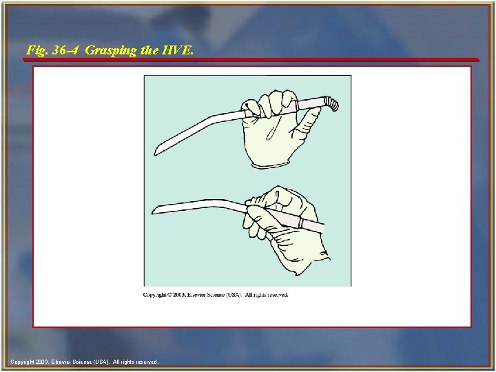 Fig. 36 -4 Grasping the HVE. Copyright 2003, Elsevier Science (USA). All rights reserved.