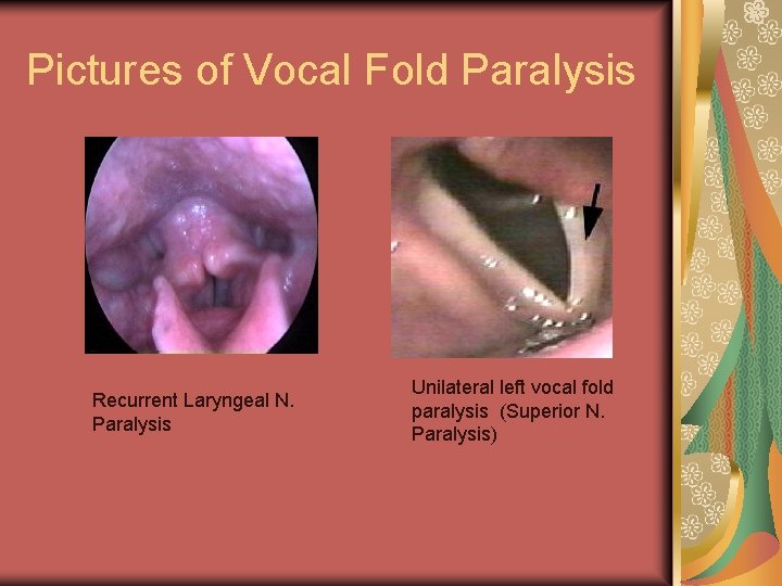 Pictures of Vocal Fold Paralysis Recurrent Laryngeal N. Paralysis Unilateral left vocal fold paralysis