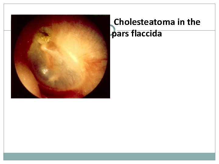 Cholesteatoma in the pars flaccida 