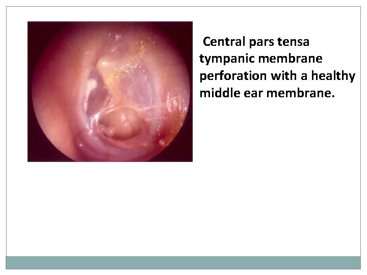 Central pars tensa tympanic membrane perforation with a healthy middle ear membrane. 