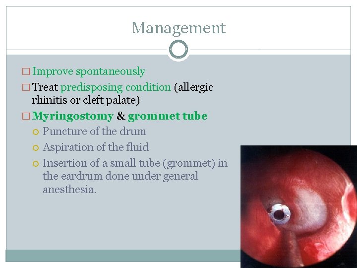 Management � Improve spontaneously � Treat predisposing condition (allergic rhinitis or cleft palate) �