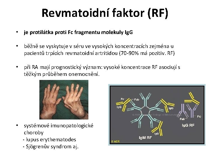 Revmatoidní faktor (RF) • je protilátka proti Fc fragmentu molekuly Ig. G • běžně