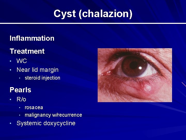 Cyst (chalazion) Inflammation Treatment • WC • Near lid margin • steroid injection Pearls