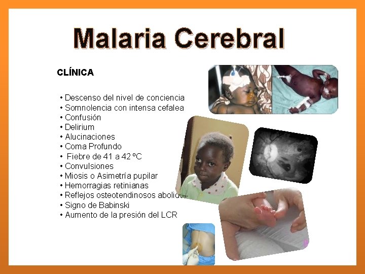 Malaria Cerebral CLÍNICA • Descenso del nivel de conciencia • Somnolencia con intensa cefalea