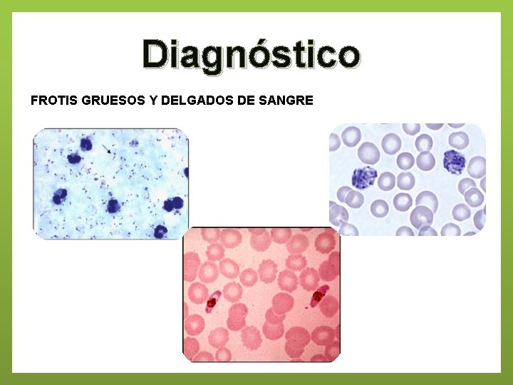 Diagnóstico FROTIS GRUESOS Y DELGADOS DE SANGRE 
