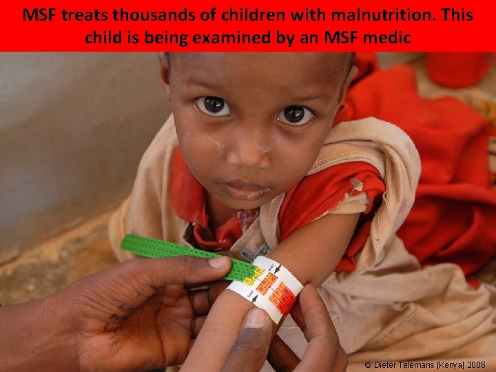 MSF treats thousands of children with malnutrition. This child is being examined by an