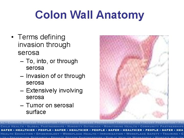 Colon Wall Anatomy • Terms defining invasion through serosa – To, into, or through Colon Wall Anatomy • Terms defining invasion through serosa – To, into, or through