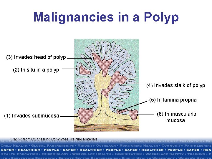 Malignancies in a Polyp (3) Invades head of polyp (2) In situ in a Malignancies in a Polyp (3) Invades head of polyp (2) In situ in a
