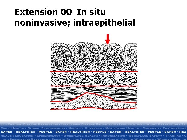 Extension 00 In situ noninvasive; intraepithelial Extension 00 In situ noninvasive; intraepithelial