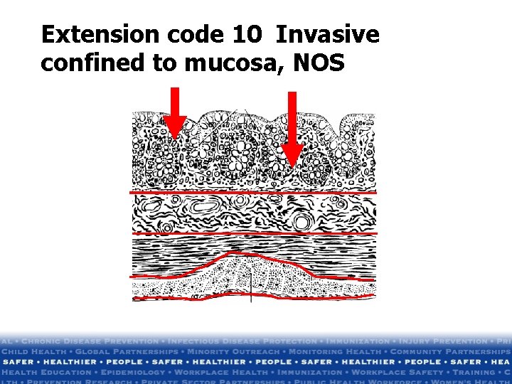 Extension code 10 Invasive confined to mucosa, NOS Extension code 10 Invasive confined to mucosa, NOS