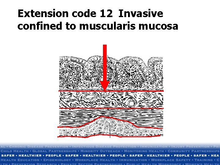 Extension code 12 Invasive confined to muscularis mucosa Extension code 12 Invasive confined to muscularis mucosa