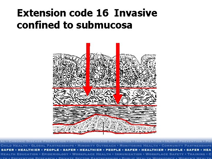 Extension code 16 Invasive confined to submucosa Extension code 16 Invasive confined to submucosa