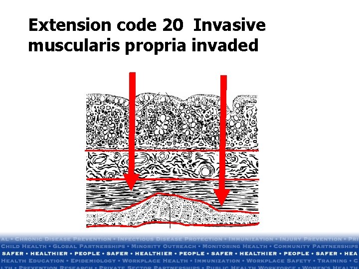 Extension code 20 Invasive muscularis propria invaded Extension code 20 Invasive muscularis propria invaded