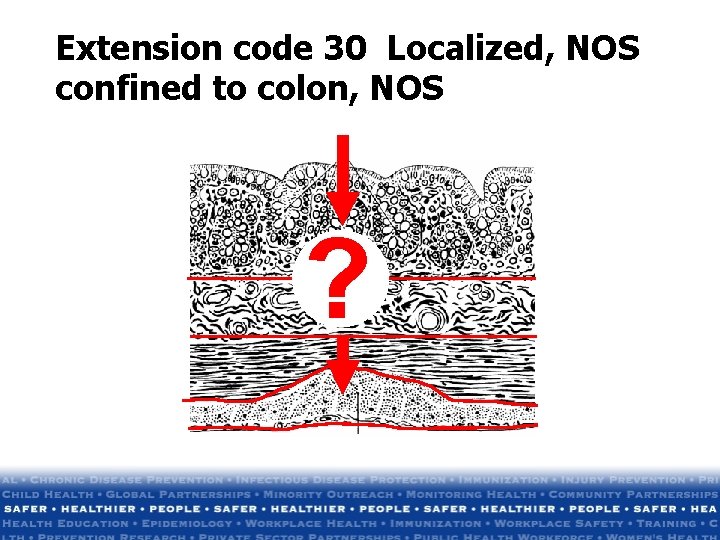 Extension code 30 Localized, NOS confined to colon, NOS ? Extension code 30 Localized, NOS confined to colon, NOS ?