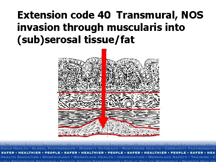 Extension code 40 Transmural, NOS invasion through muscularis into (sub)serosal tissue/fat Extension code 40 Transmural, NOS invasion through muscularis into (sub)serosal tissue/fat