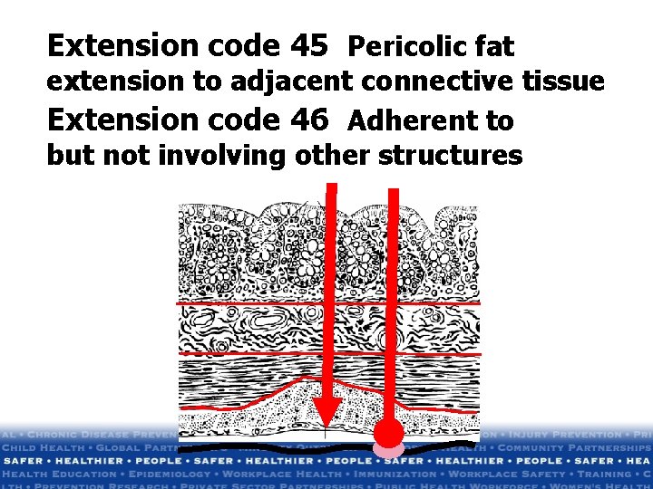 Extension code 45 Pericolic fat extension to adjacent connective tissue Extension code 46 Adherent Extension code 45 Pericolic fat extension to adjacent connective tissue Extension code 46 Adherent