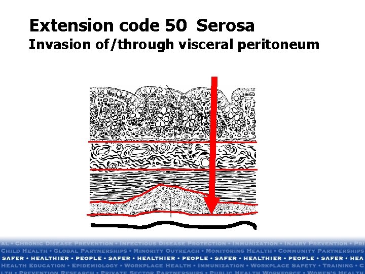 Extension code 50 Serosa Invasion of/through visceral peritoneum Extension code 50 Serosa Invasion of/through visceral peritoneum