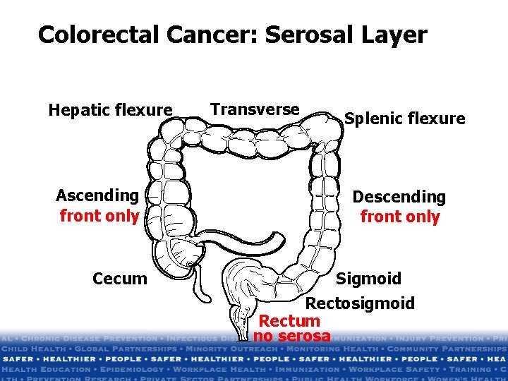 Colorectal Cancer: Serosal Layer Hepatic flexure Ascending front only Cecum Transverse Splenic flexure Descending Colorectal Cancer: Serosal Layer Hepatic flexure Ascending front only Cecum Transverse Splenic flexure Descending
