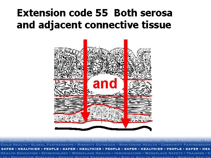 Extension code 55 Both serosa and adjacent connective tissue and Extension code 55 Both serosa and adjacent connective tissue and
