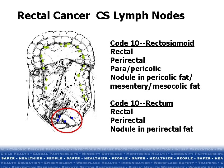 Rectal Cancer CS Lymph Nodes Code 10 --Rectosigmoid Rectal Perirectal Para/pericolic Nodule in pericolic Rectal Cancer CS Lymph Nodes Code 10 --Rectosigmoid Rectal Perirectal Para/pericolic Nodule in pericolic