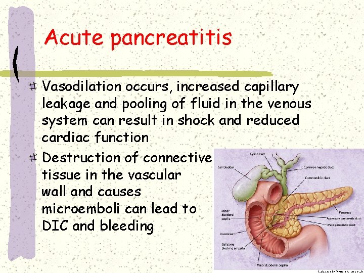 Acute pancreatitis Vasodilation occurs, increased capillary leakage and pooling of fluid in the venous Acute pancreatitis Vasodilation occurs, increased capillary leakage and pooling of fluid in the venous