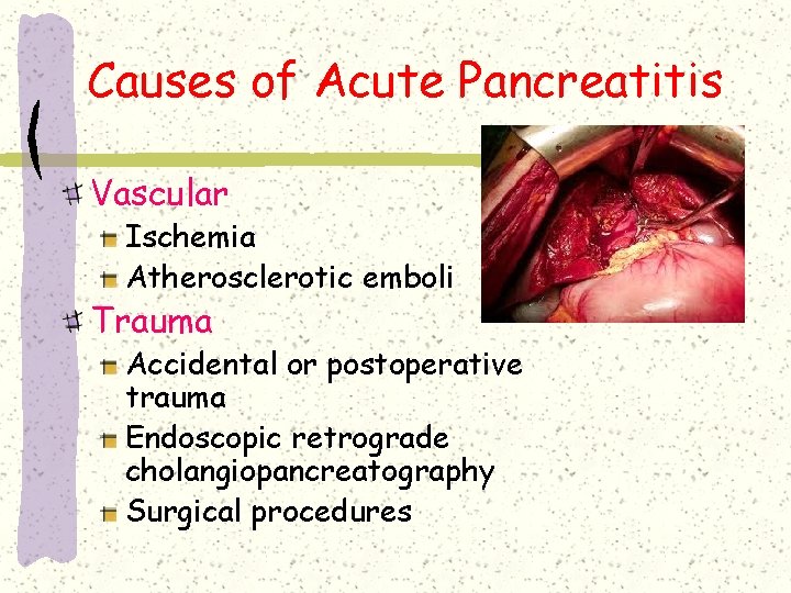 Causes of Acute Pancreatitis Vascular Ischemia Atherosclerotic emboli Trauma Accidental or postoperative trauma Endoscopic Causes of Acute Pancreatitis Vascular Ischemia Atherosclerotic emboli Trauma Accidental or postoperative trauma Endoscopic