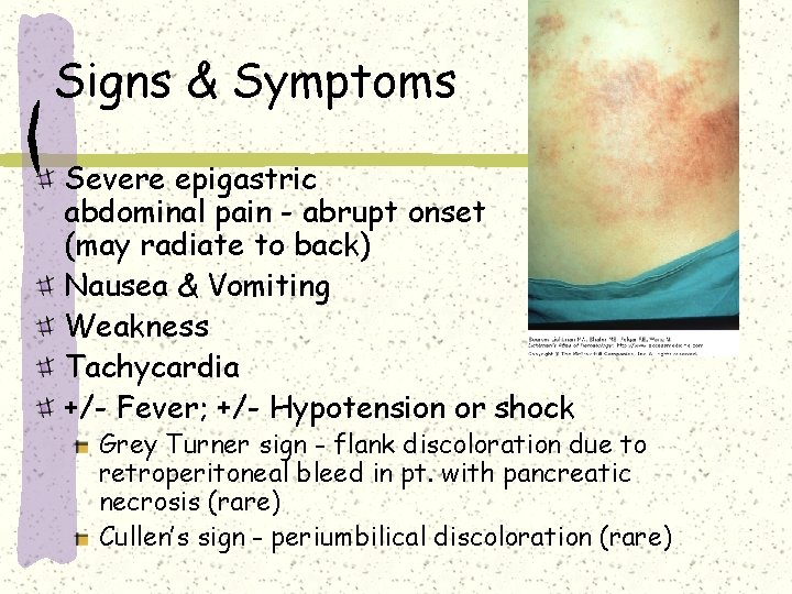Signs & Symptoms Severe epigastric abdominal pain - abrupt onset (may radiate to back) Signs & Symptoms Severe epigastric abdominal pain - abrupt onset (may radiate to back)