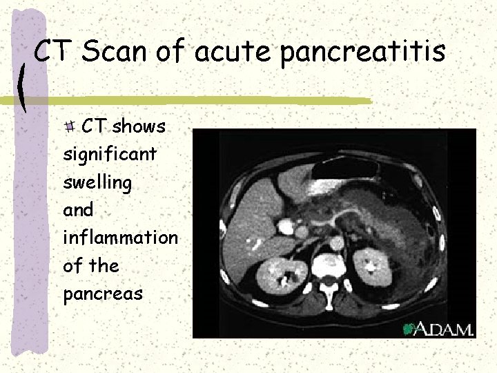 CT Scan of acute pancreatitis CT shows significant swelling and inflammation of the pancreas CT Scan of acute pancreatitis CT shows significant swelling and inflammation of the pancreas