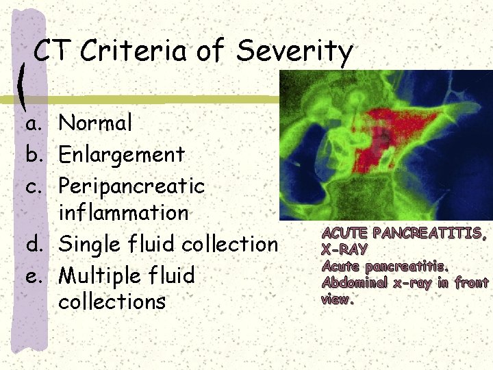 CT Criteria of Severity a. Normal b. Enlargement c. Peripancreatic inflammation d. Single fluid CT Criteria of Severity a. Normal b. Enlargement c. Peripancreatic inflammation d. Single fluid
