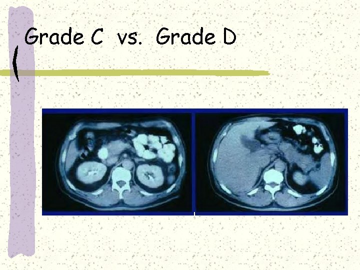 Grade C vs. Grade D Grade C vs. Grade D