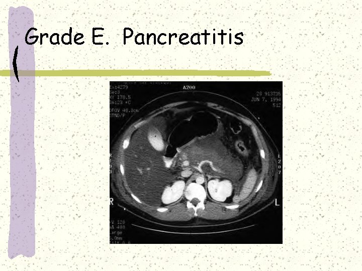 Grade E. Pancreatitis Grade E. Pancreatitis