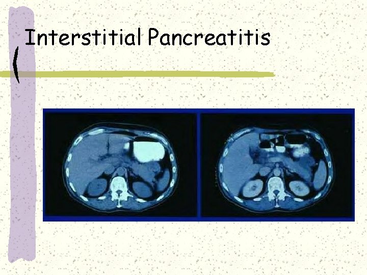 Interstitial Pancreatitis Interstitial Pancreatitis