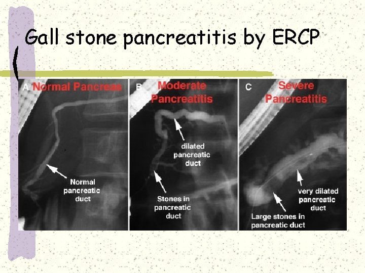 Gall stone pancreatitis by ERCP Gall stone pancreatitis by ERCP
