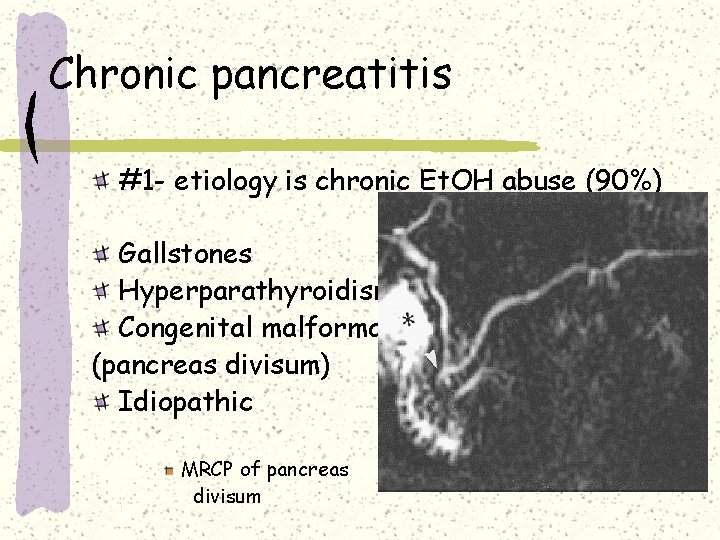 Chronic pancreatitis #1 - etiology is chronic Et. OH abuse (90%) Gallstones Hyperparathyroidism Congenital Chronic pancreatitis #1 - etiology is chronic Et. OH abuse (90%) Gallstones Hyperparathyroidism Congenital