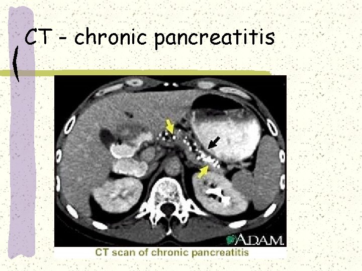 CT - chronic pancreatitis CT - chronic pancreatitis