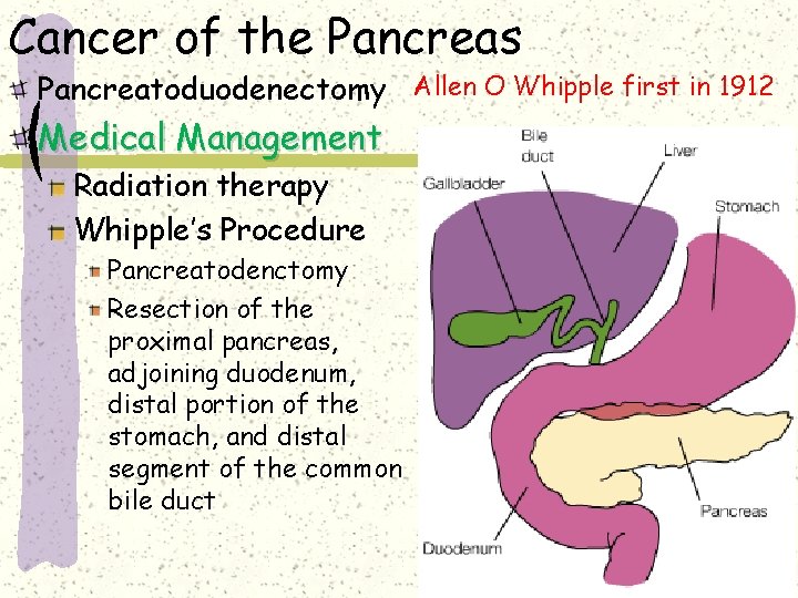 Cancer of the Pancreas Pancreatoduodenectomy Allen O Whipple first in 1912 Medical Management Radiation Cancer of the Pancreas Pancreatoduodenectomy Allen O Whipple first in 1912 Medical Management Radiation