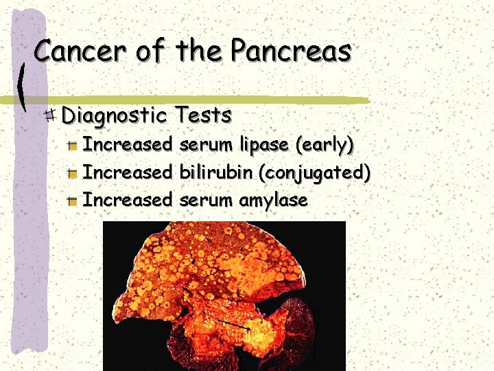 Cancer of the Pancreas Diagnostic Tests Increased serum lipase (early) Increased bilirubin (conjugated) Increased Cancer of the Pancreas Diagnostic Tests Increased serum lipase (early) Increased bilirubin (conjugated) Increased