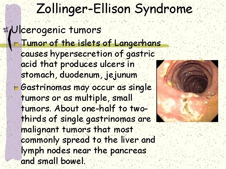 Zollinger-Ellison Syndrome Ulcerogenic tumors Tumor of the islets of Langerhans causes hypersecretion of gastric Zollinger-Ellison Syndrome Ulcerogenic tumors Tumor of the islets of Langerhans causes hypersecretion of gastric