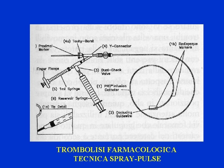 TROMBOLISI FARMACOLOGICA TECNICA SPRAY-PULSE 