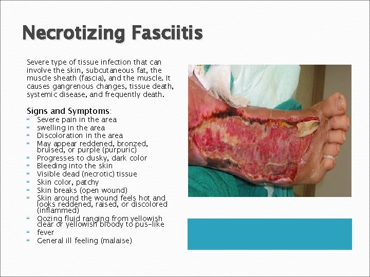 Necrotizing Fasciitis Severe type of tissue infection that can involve the skin, subcutaneous fat,