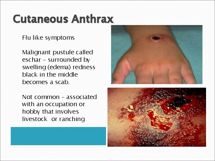 Cutaneous Anthrax Flu like symptoms Malignant pustule called eschar – surrounded by swelling (edema)