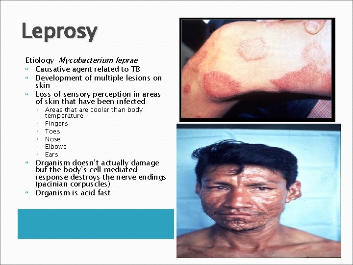 Leprosy Etiology Mycobacterium leprae Causative agent related to TB Development of multiple lesions on