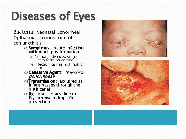 Diseases of Eyes Bacterial Neonatal Gonorrheal Opthalmia: serious form of conjunctivitis Symptoms: Acute infection