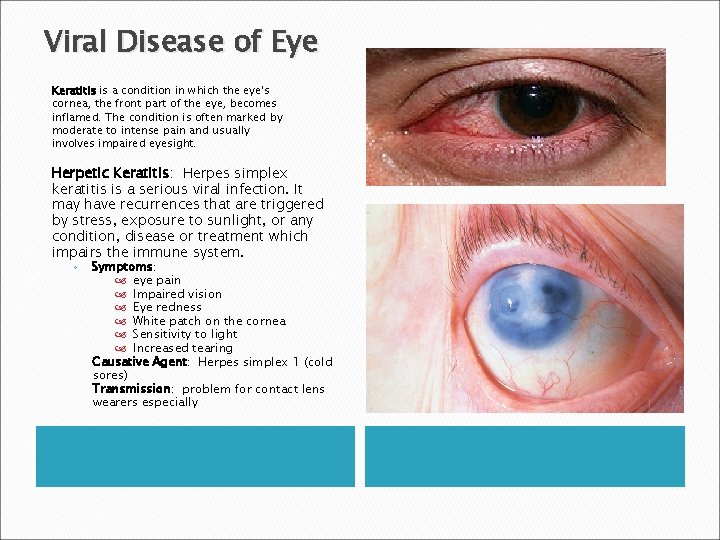 Viral Disease of Eye Keratitis is a condition in which the eye's cornea, the