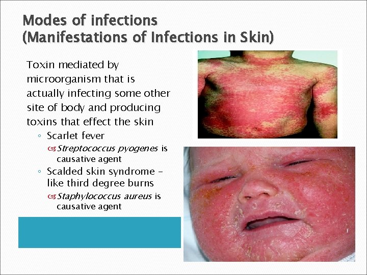 Modes of infections (Manifestations of Infections in Skin) Toxin mediated by microorganism that is