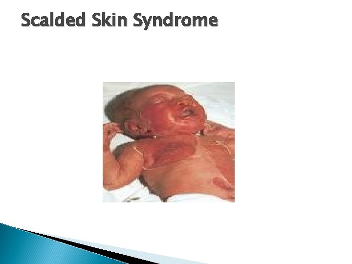 Scalded Skin Syndrome 