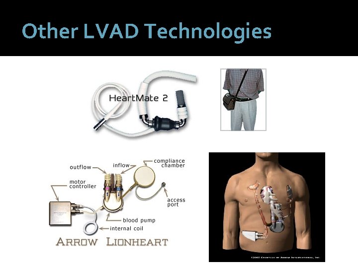 Other LVAD Technologies 