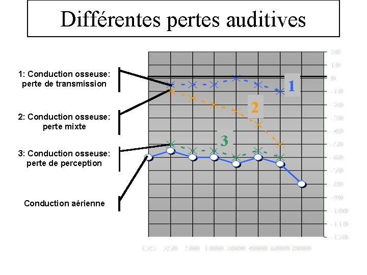 Différentes pertes auditives 1: Conduction osseuse: perte de transmission 1 2 2: Conduction osseuse: